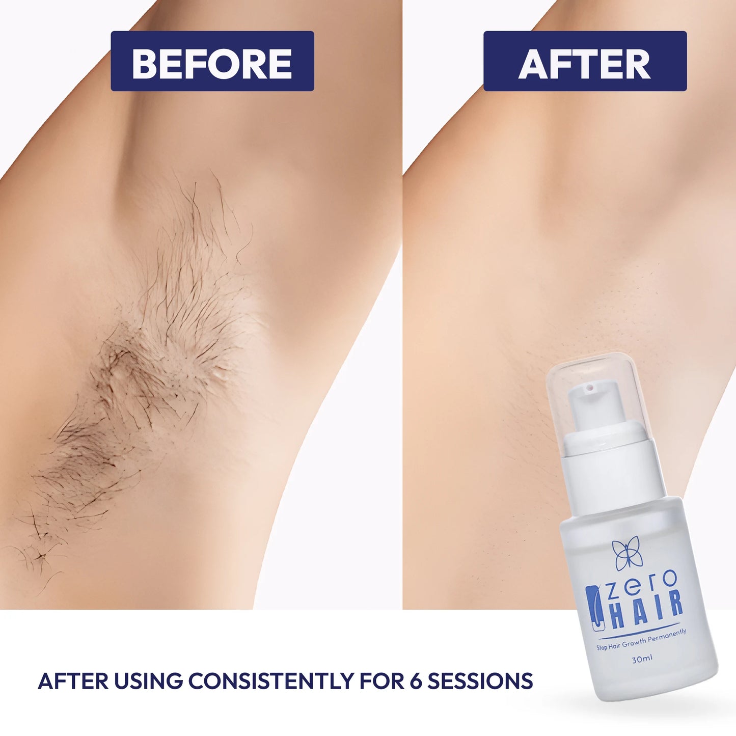 ZERO HAIR SERUM-Permanently Stop Hair